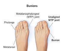 Bunions