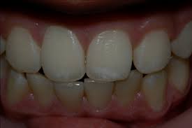 Image result for fluorosis