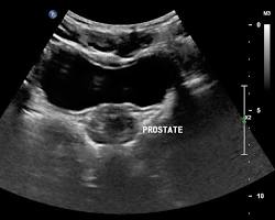 Image of Ultrasound of the prostate gland