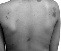 Kết quả hình ảnh cho u sợi thần kinh