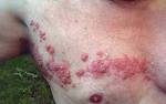 Zoster herpes