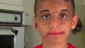 Iraqi boy set on fire now stands tall - 130319120231-dnt-gupta-youssif-beyond-the-burns-00021021-story-body