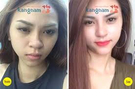 Địa chỉ nâng mũi tuyệt vời nhất bạn nên chọn