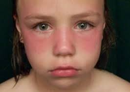 image: girl sunburned. Parents especially need to get sunblock on their kids before going into the sun. Photo by Shawn Wright - sunburn_shawn_wright