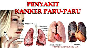 Image result for kanker