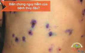 Kết quả hình ảnh cho thủy đậu