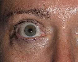 patient with Thyroid Eye Disease