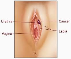 Image result for kanker