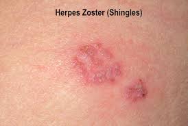 Image result for "Herpes Zoster"