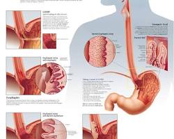 Image of GERD anatomy diagram