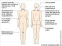 Fibromyalgi - 