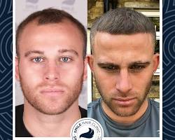Image of Hair transplant in Turkey