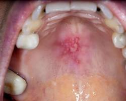 Image of Canker sore on the roof of the mouth