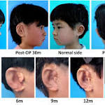  Five children have been given a new EAR made from their own cells using a world first technique