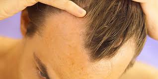 SAÇ DÖKÜLMESİ ile ilgili görsel sonucu