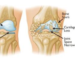 Bildmotiv: Osteoarthritis in the knee