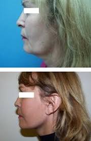 Photos avant/après intervention Lifting facial du chirurgien Dr Jean-Luc Jauffret - 616444