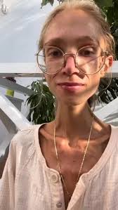 Sofia Kenin Skin Condition