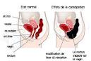 Constipation - Que manger? - Sant-Mdecine