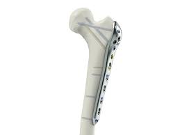 MISS Proximal Femur Plates – TST
