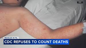 Trumps' new CDC director ordered delay in counting 2 measles-related deaths in Pennsylvania