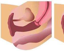 Image of Comparison between a normal vagina and a tightened vagina