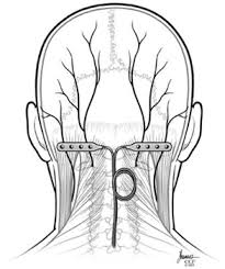 Occipital nerve stimulator