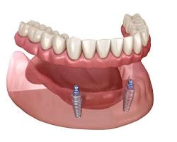Implantsupported dentures