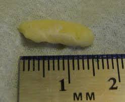 Image result for tonsilith