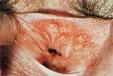 Herpes genitalis: Symptome Apotheken Umschau