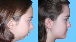 Image result for jaw surgery