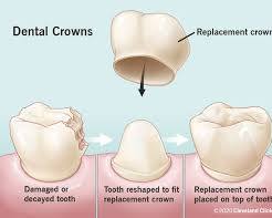 Dental crown