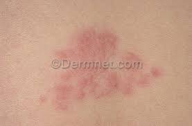 Image result for "Herpes Zoster"