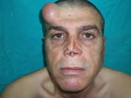 Mardin Devlet Hastanesi Plastik Rekonstrüktif ve Estetik Cerrahi Uzmanı Dr. Barış Yiğit, cilt kanseri nedeniyle birçok kez ameliyat geçiren ve burnunda ... - ibrahim-ulger