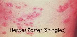Image result for "Herpes Zoster"