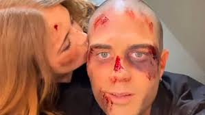 Max George Returns to Stage with Maisie Smith After Double Heart Surgery Scare