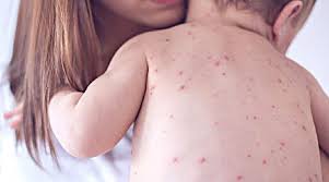 Trend Google: morbillo