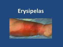 Hasil gambar untuk Erysipelas
