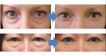 Under Eye Bag Removal in Los Angeles Beverly Hills at Epione