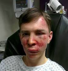 Savage attack: Andrew Thornton, who suffers cerebral palsy, was left with boot prints on his face after he was savagely attacked in a park while walking his ... - article-2298897-18E8A238000005DC-161_634x659