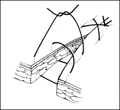 Image result for simple continuous suture pattern