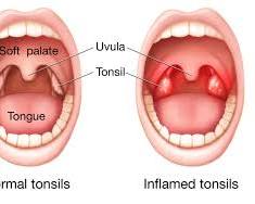 Image of Swollen tonsils