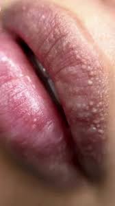 Belani reduces Fordyce stains with 5 times greater ...