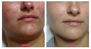 Картинки по запросу salicylic peel