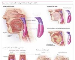 Image of Human OSA poster illustrating the anatomical structures involved in obstructive sleep apnea
