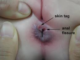 Fisura anala