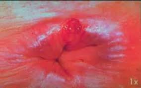 Résultat de recherche d'images pour "anus 13 plis"