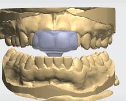 Image of NTIbite splint