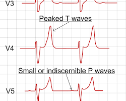 Image of EKG tracing showing hyperkalemia