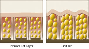 نتيجة بحث الصور عن ‪Cellulite‬‏